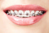 Metal Braces | Oldham | Manchester Orthodontics
