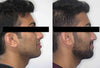 Orthognathic surgery