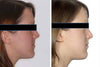 Orthognathic surgery