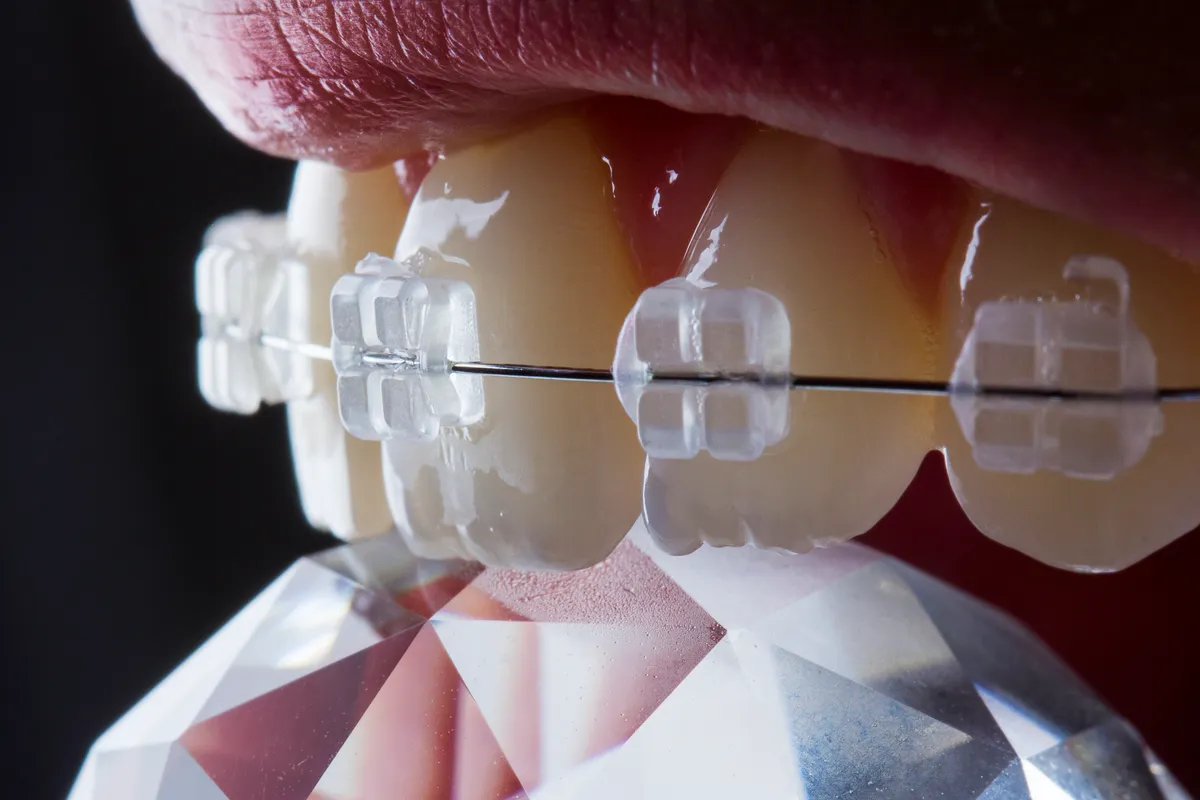 A patient at a ceramic braces adjustment appointment