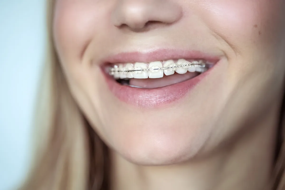 Ceramic Braces