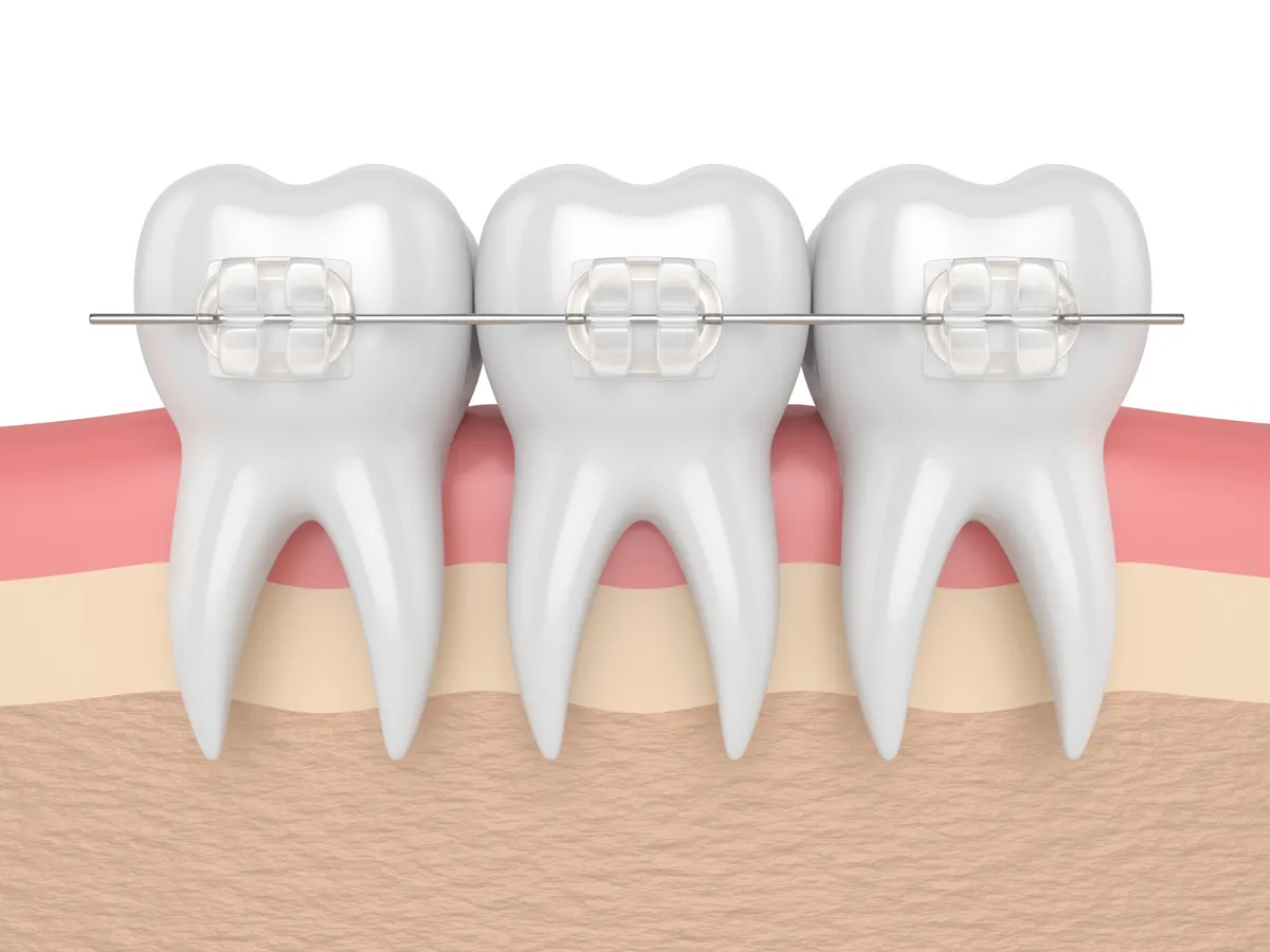 A patient smiling with ceramic braces