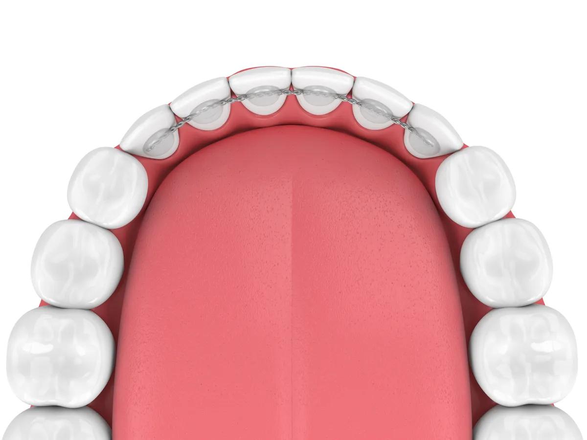 A patient confidently going about everyday life during lingual braces treatment