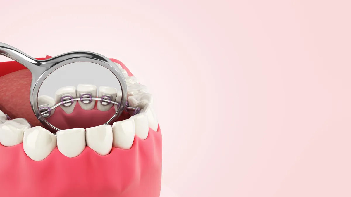 A close-up of lingual braces fitted behind the teeth