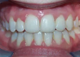 After treatment