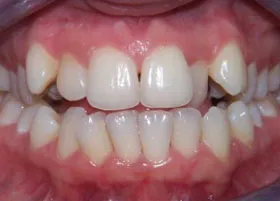 Before treatment