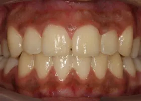 After treatment