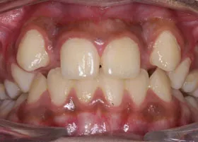 Before treatment