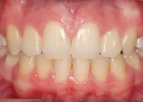 After treatment