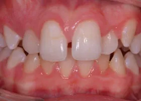 Before treatment