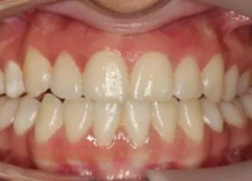 After treatment