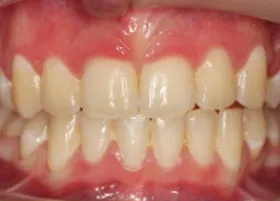 After treatment