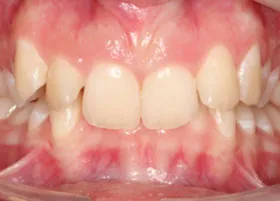 Before treatment