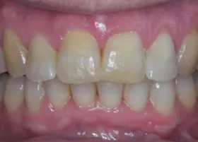 After treatment