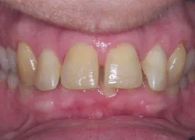 Before treatment