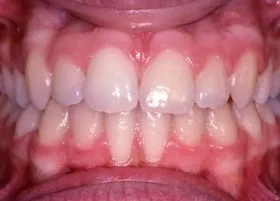 After treatment