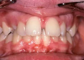 Before treatment
