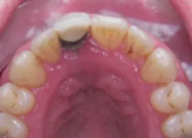 After treatment