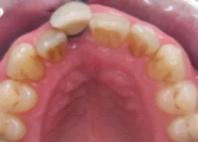 Before treatment