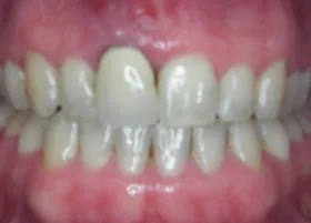 After treatment