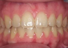 After treatment