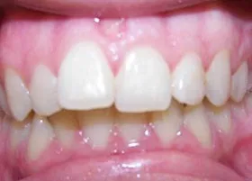 Before treatment