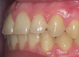 After treatment