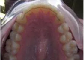 After treatment