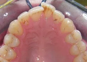 Before treatment