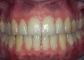 After treatment