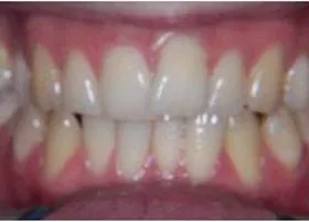 Before treatment