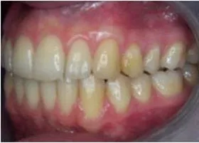 After treatment