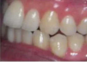 Before treatment