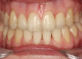 After treatment