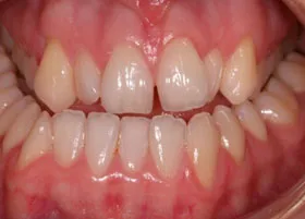 Before treatment