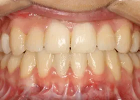 After treatment