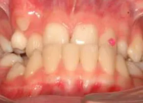 Before treatment