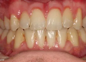 After treatment