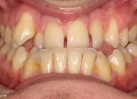 Before treatment
