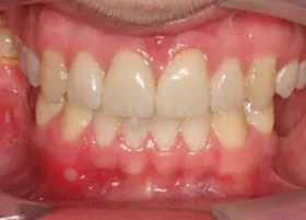 After treatment
