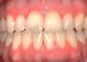 After treatment
