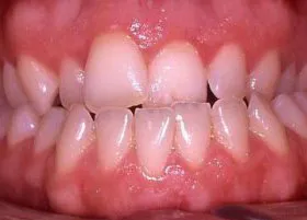 Before treatment