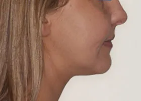 After treatment
