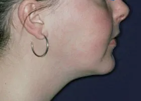 After treatment
