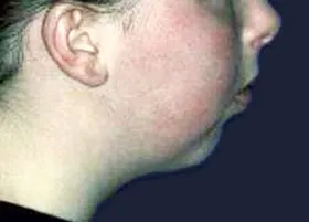 Before treatment