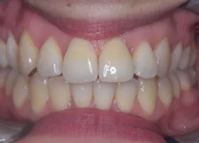 After treatment
