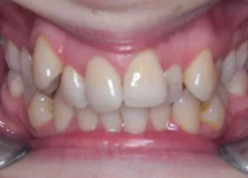 Before treatment