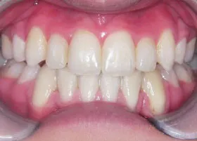 After treatment