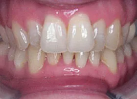 After treatment