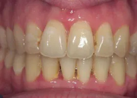 Before treatment